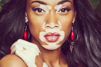 Winnie Harlow.. عارضة ازياء جعلت من المرض سبباً لتمييزها