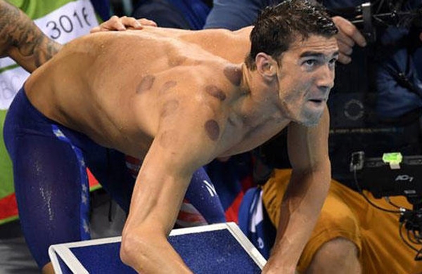 لاعبو أميركا يستعينون بالحجامة للفوز في أولمبياد ريو 