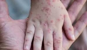 الولايات المتحدة الأمريكية ... مسرح لأكبر تفشٍ لجدري القرود في العالم