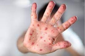 منظمة الصحة العالمية: أميرکا وأوروبا تتصدران انتشار فيروس جدري القرود