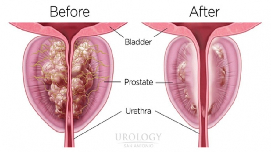 ابتكار تقنية جديدة لعلاج ورم البروستاتا الحميد في روسيا دون جراحة وإعادته لوضعه الطبيعي