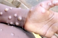 الصحة العالمية تدعو أوروبا ل تكثيف جهودها لتجنب توطن جدري القردة في منطقة جغرافية أكبر