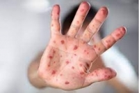 منظمة الصحة العالمية: أميرکا وأوروبا تتصدران انتشار فيروس جدري القرود